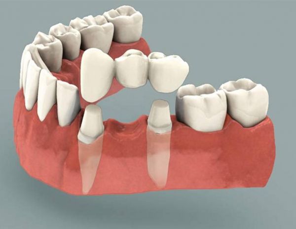 Crowns & Bridges at Keluarga Dental Smile, Sentul Kuala Lumpur